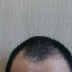 【悲報】ハゲてきた。M字型にハゲてきた。父親もおじいちゃんもハゲだった。兄貴もハゲてきてる